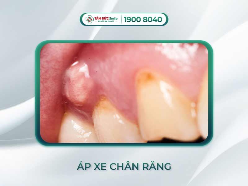 ÁP XE RĂNG CÓ NGUY HIỂM KHÔNG? CÁCH PHÒNG NGỪA ÁP XE CHÂN RĂNG HIỆU QUẢ