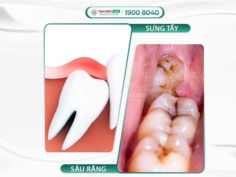 BỊ SƯNG NƯỚU RĂNG TRONG CÙNG: NGUYÊN NHÂN VÀ CÁCH CHỮA NHANH KHỎI