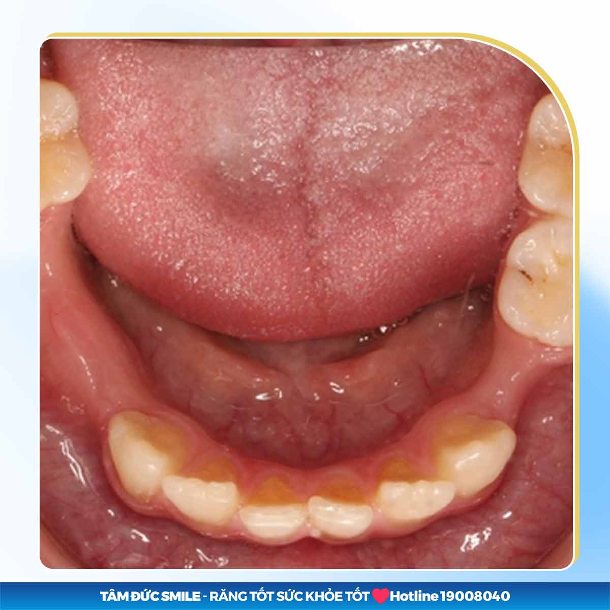 BỊ TIÊU XƯƠNG HÀM CÓ TRỒNG RĂNG ĐƯỢC KHÔNG? TIÊU XƯƠNG HÀM CÓ NGUY HIỂM KHÔNG?