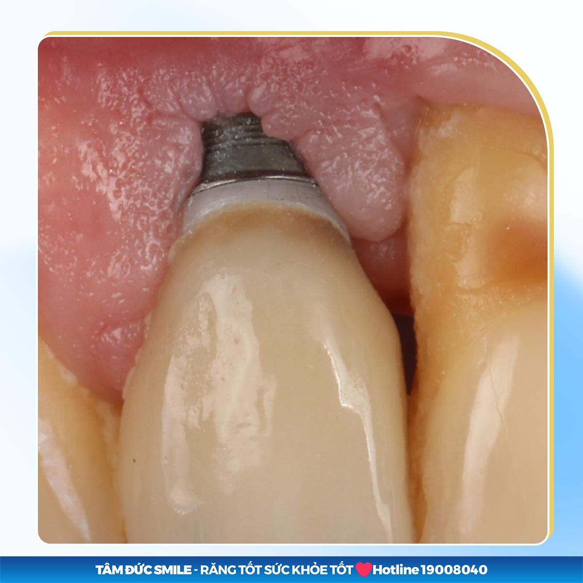 5 BIẾN CHỨNG IMPLANT THƯỜNG GẶP KHI TRỒNG RĂNG SAI CÁCH