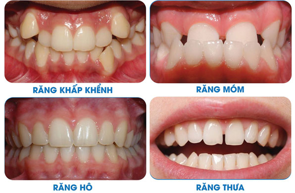 CAC-TRUONG-HOP-NEN-CHON-NIENG-RANG