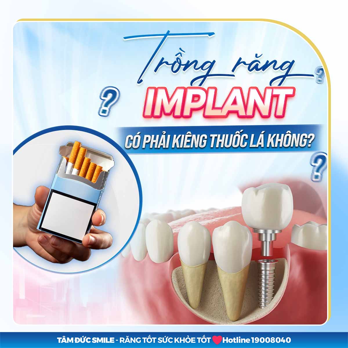 CẨM NANG TRỒNG RĂNG IMPLANT: 20+ LỜI GIẢI ĐÁP NHANH VỀ TRỒNG RĂNG IMPLANT