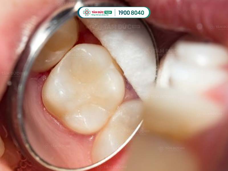 răng sau khi được trám và tạo hình