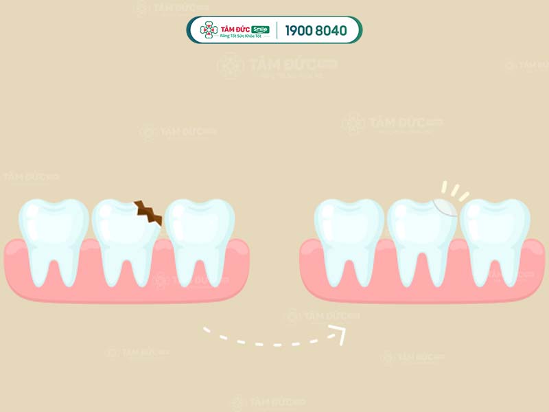 răng trước và sau khi trám