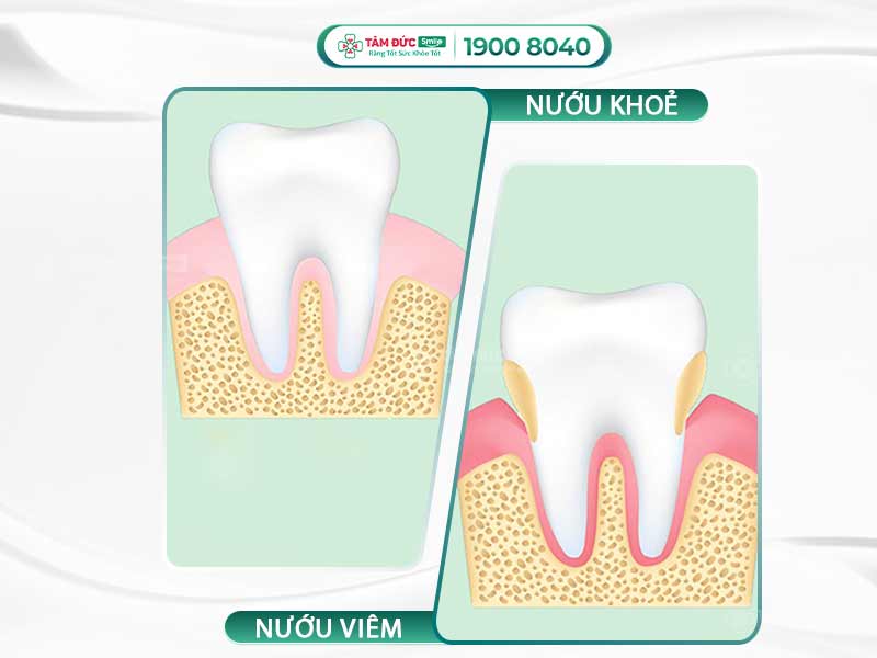 CẤU TẠO NƯỚU RĂNG NHƯ THẾ NÀO? LÀM GÌ ĐỂ BẢO VỆ NƯỚU LUÔN KHOẺ MẠNH?
