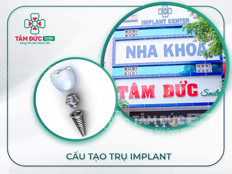 CẤU TẠO RĂNG IMPLANT VÀ ĐỊA CHỈ CẤY GHÉP IMPLANT UY TÍN