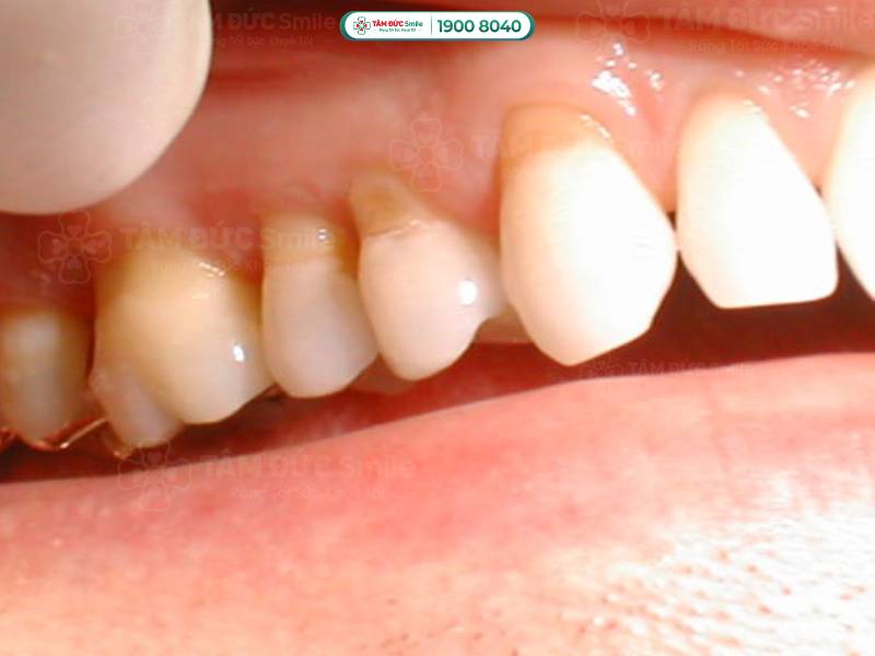 chân răng bị mòn có chữa được không