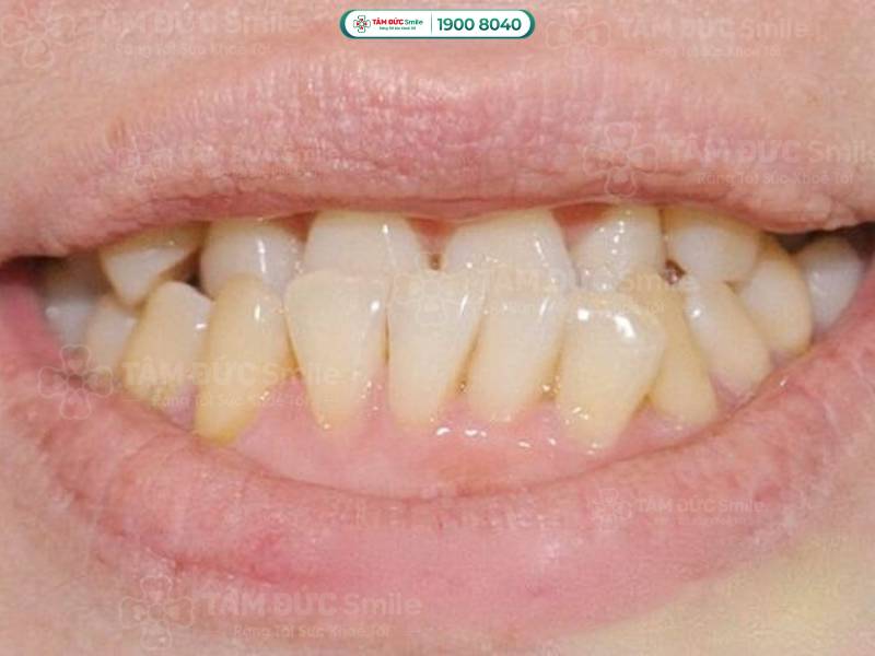 chân răng bị mòn có chữa được không