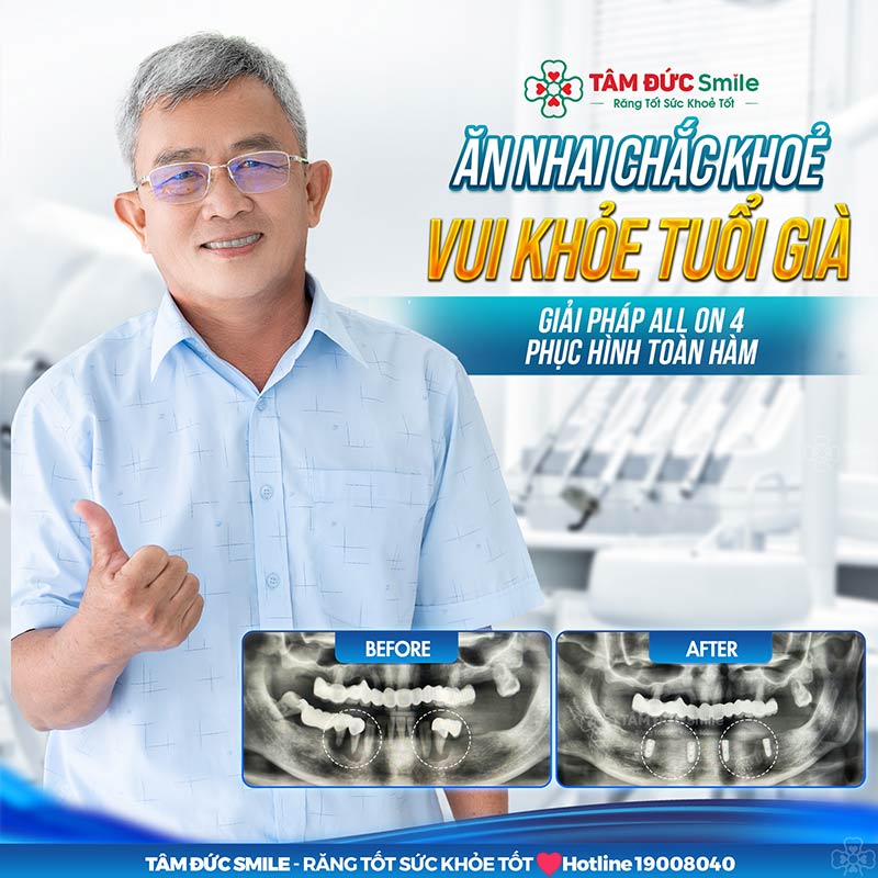 chi phí trồng răng implant all on 4