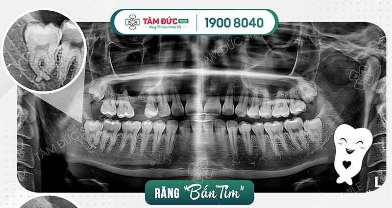 CÓ NÊN NHỔ RĂNG KHÔN KHÔNG?