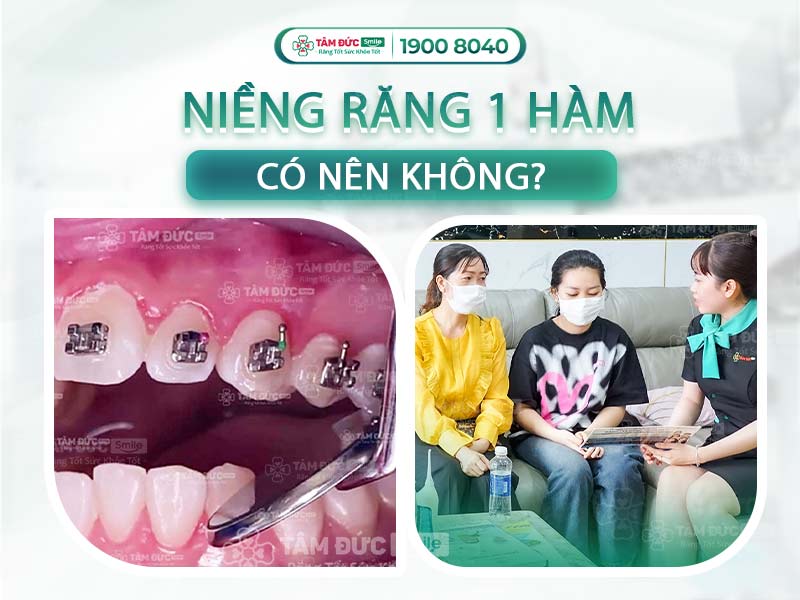 CÓ NÊN NIỀNG RĂNG HÀM TRÊN MÀ BỎ QUA HÀM DƯỚI KHÔNG?