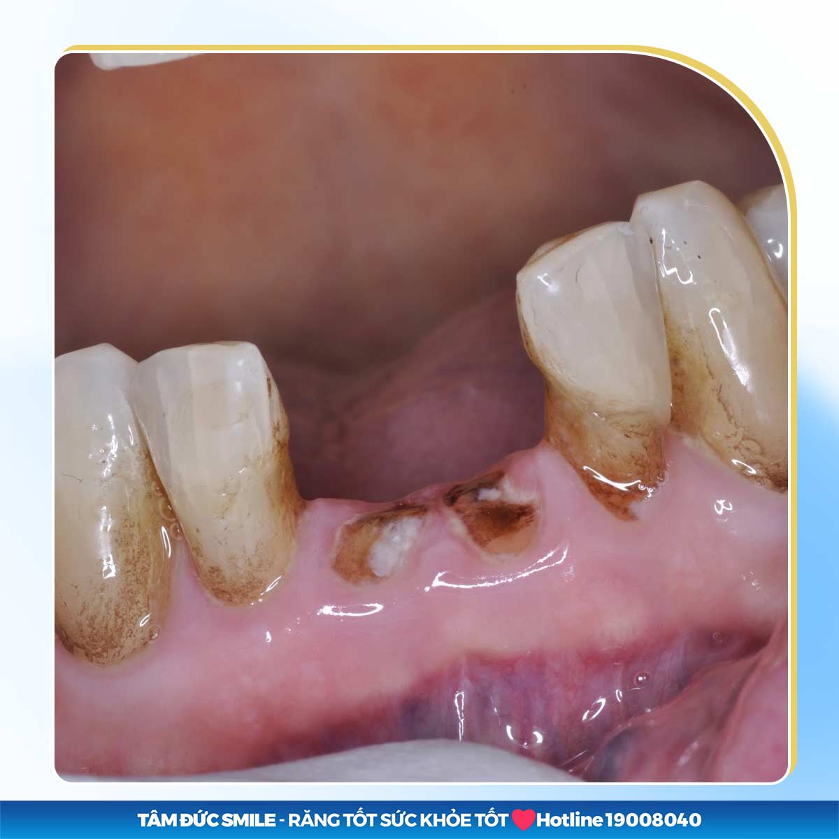 còn chân răng có bị tiêu xương không