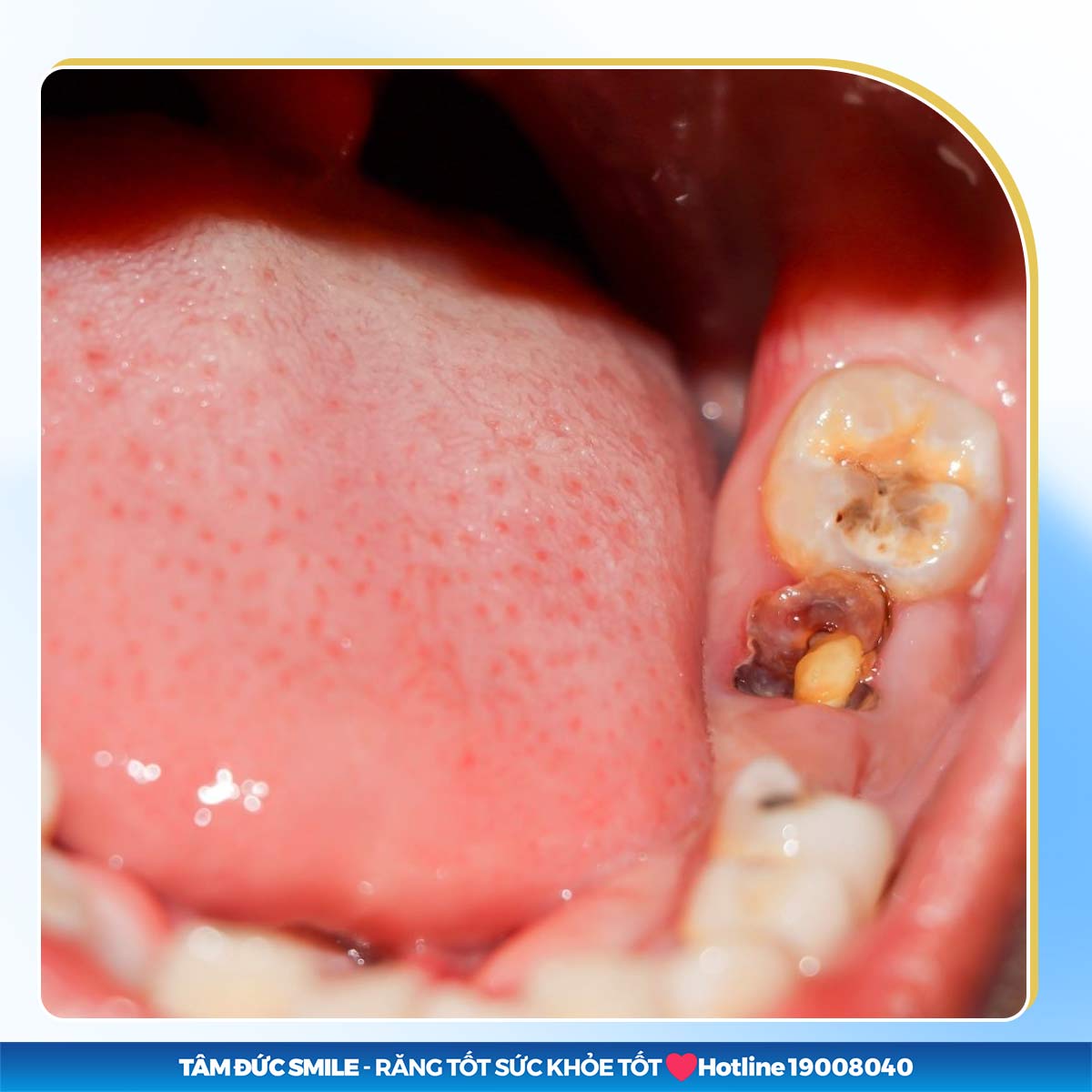 còn chân răng có nên nhổ không