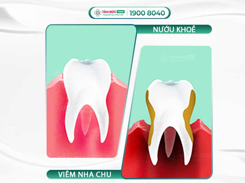 DẤU HIỆU BỆNH VIÊM NHA CHU