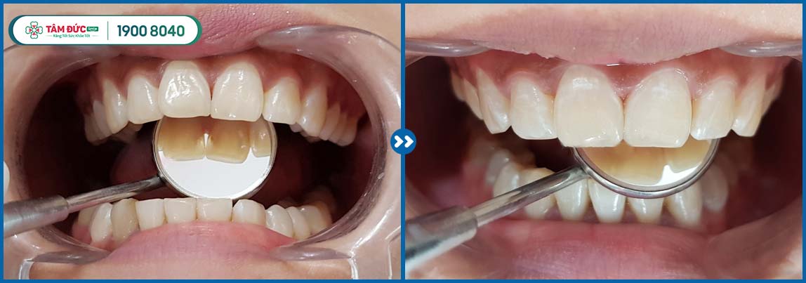 trám răng thẩm mỹ ở nha khoa Tâm Đức Smile