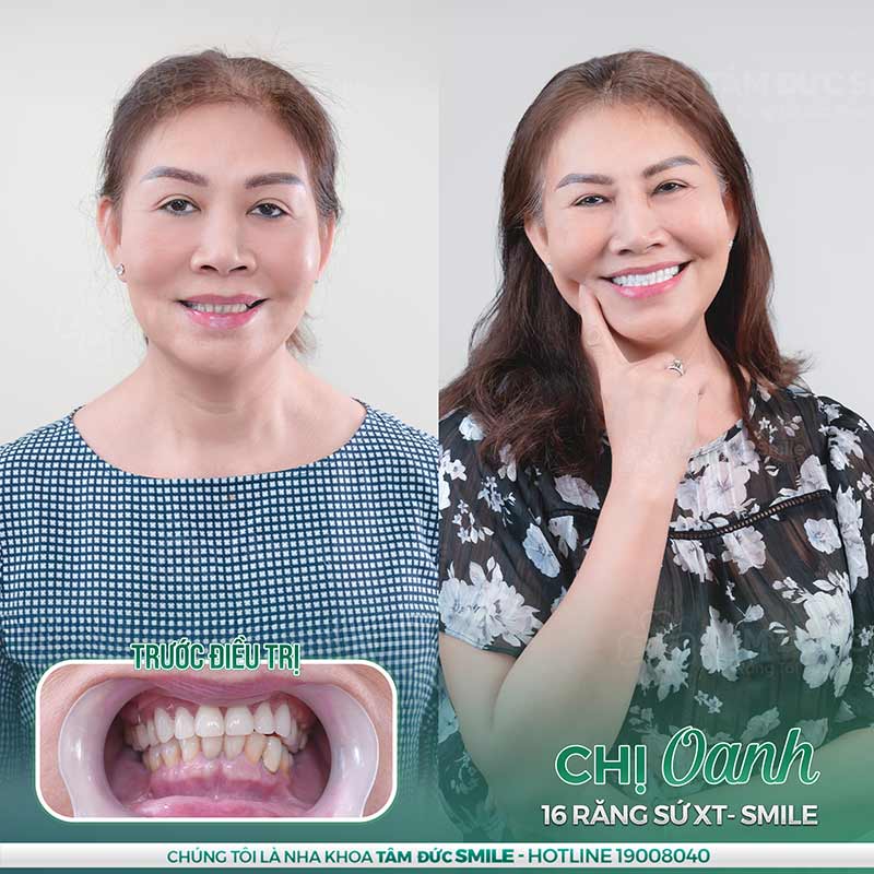 ê nguyên hàm răng là do đâu