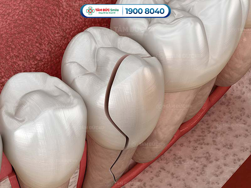 Gãy răng hàm gây nên hiện tượng lệch hàm, viêm nhiễm, mất răng và nhiều vấn đề sức khỏe