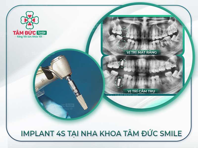 GIÁ TRỒNG RĂNG IMPLANT 4S - GIẢI PHÁP ĐƯỢC VIỆT KIỀU YÊU CHUỘNG