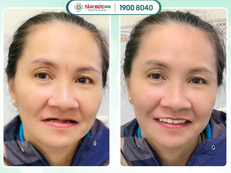 ưu nhược điểm của hàm giả tháo lắp