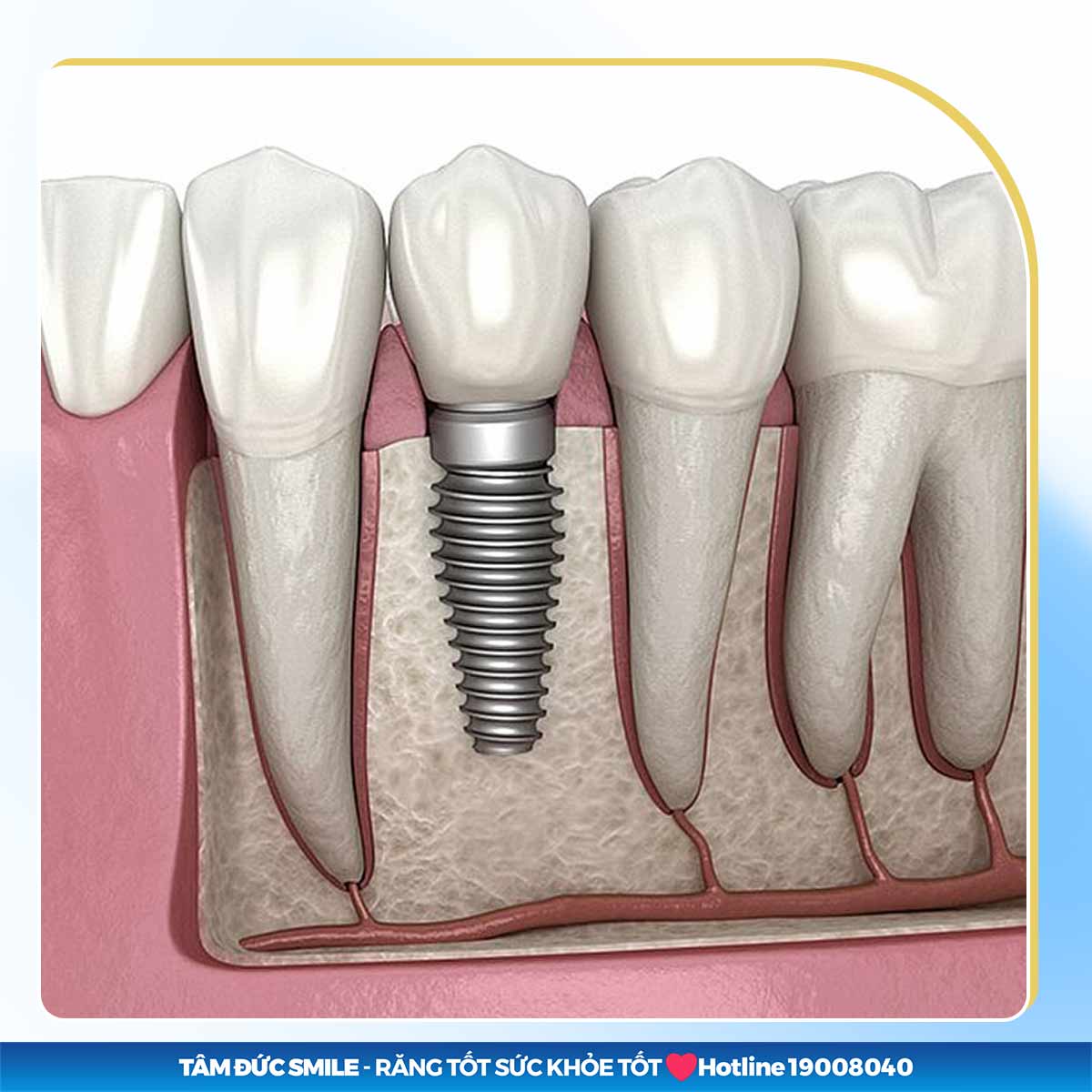 implant nha khoa là gì