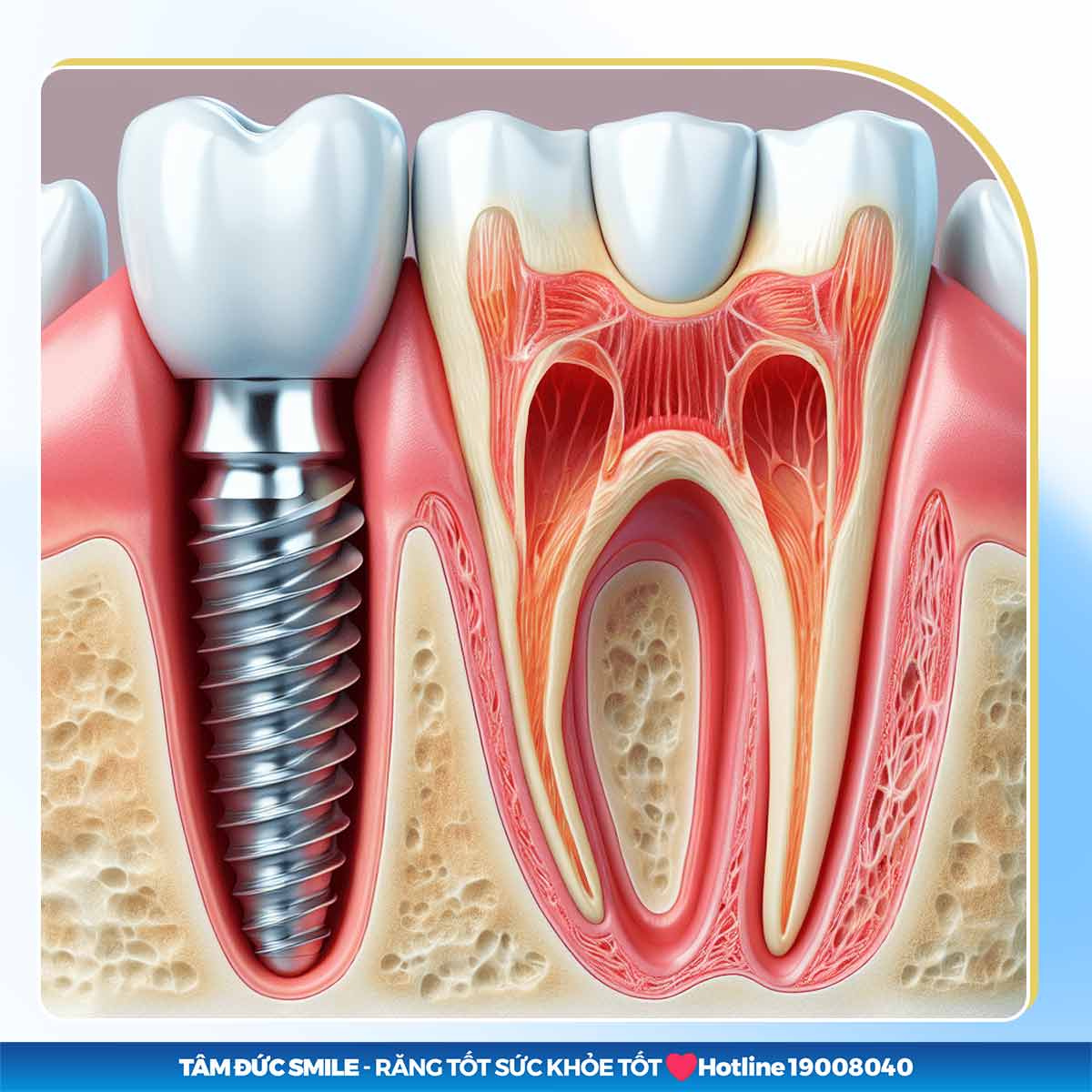 IMPLANT NHA KHOA LÀ GÌ? MỘT SỐ LƯU Ý KHI THỰC HIỆN CẤY GHÉP IMPLANT