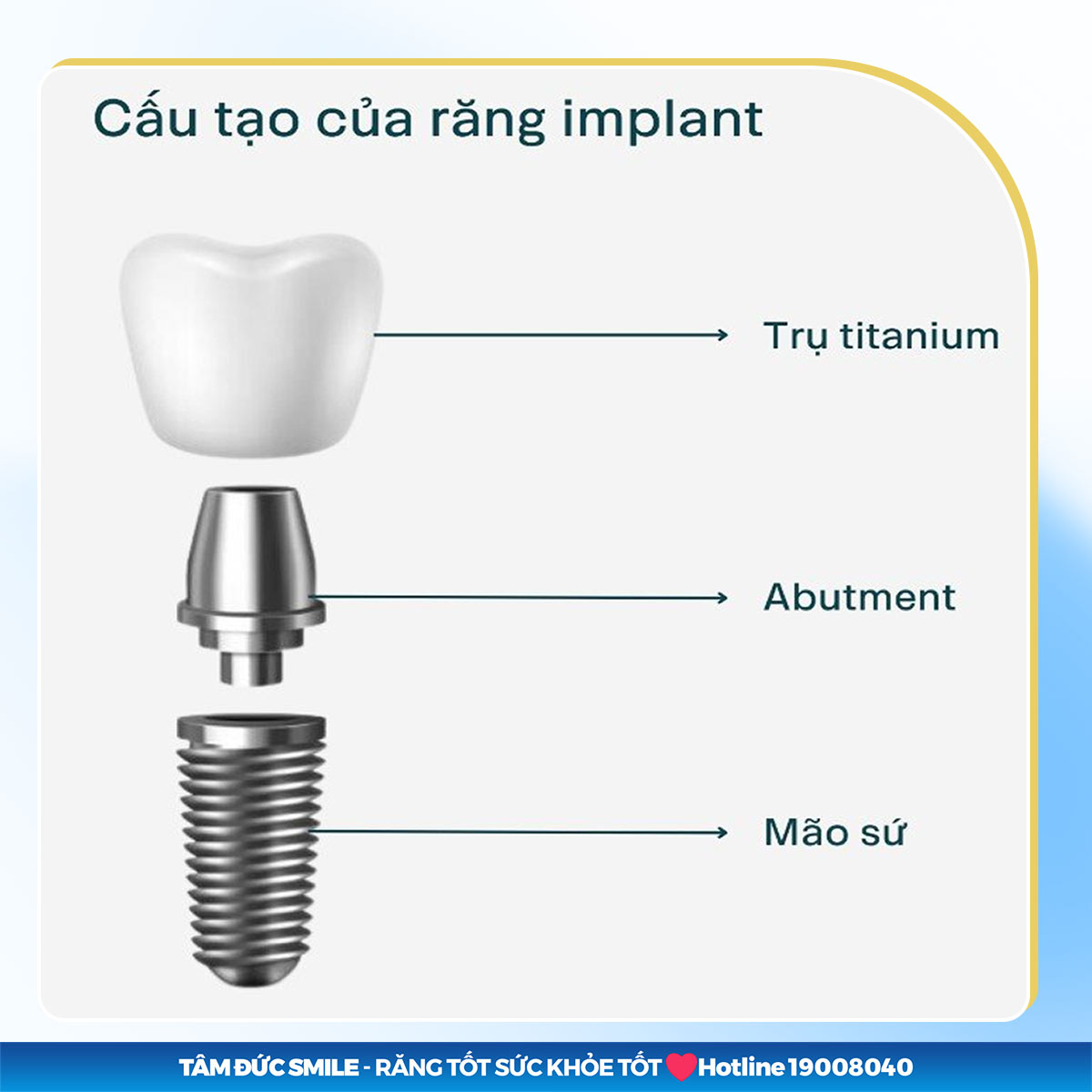 implant nha khoa là gì