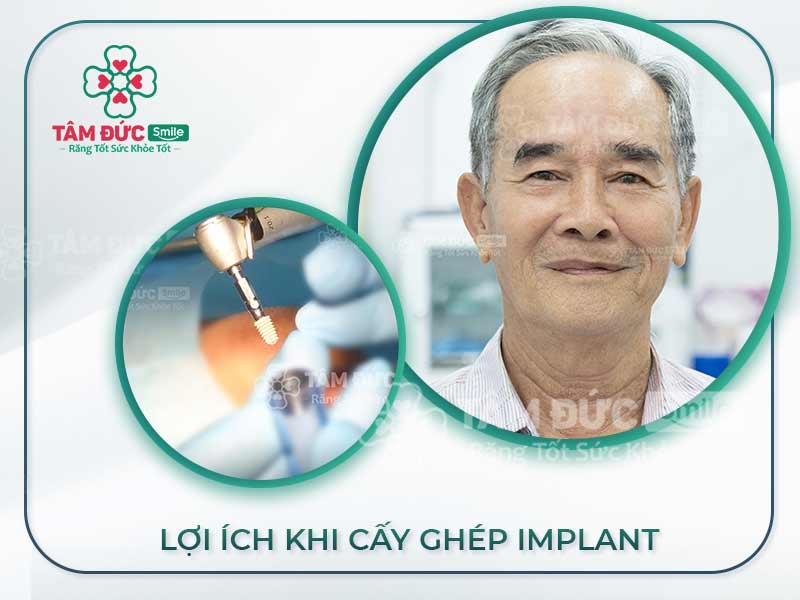 CẤY GHÉP IMPLANT Ở ĐÂU UY TÍN?