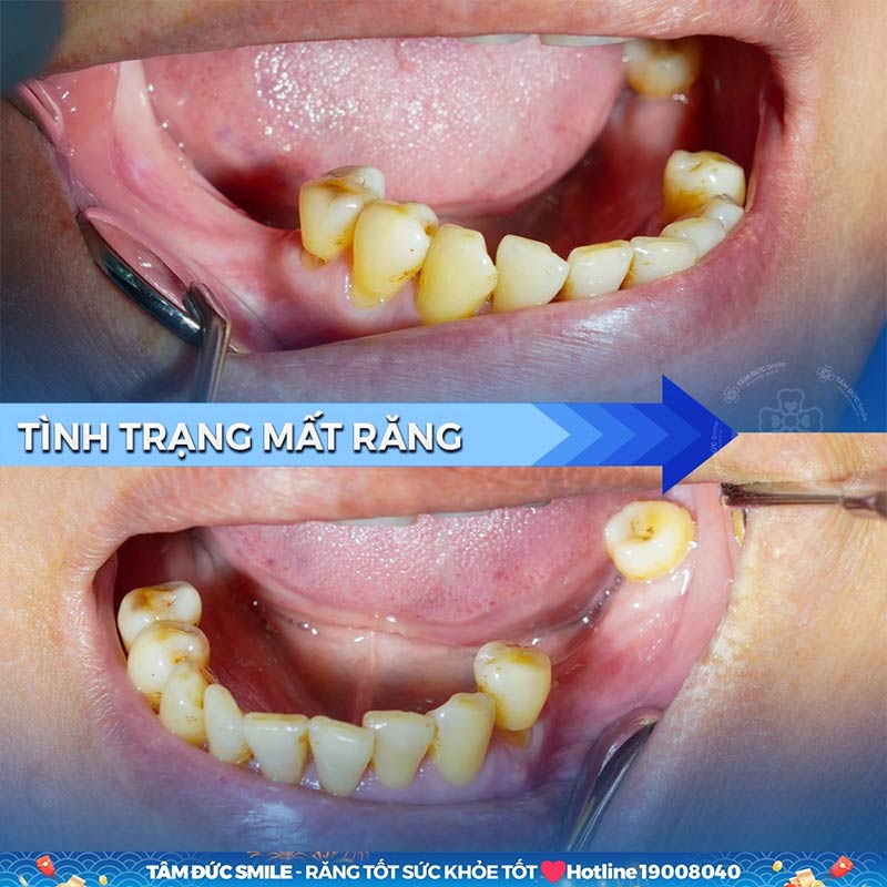 mất răng số 7 hàm dưới gây khó khăn cho việc ăn uống