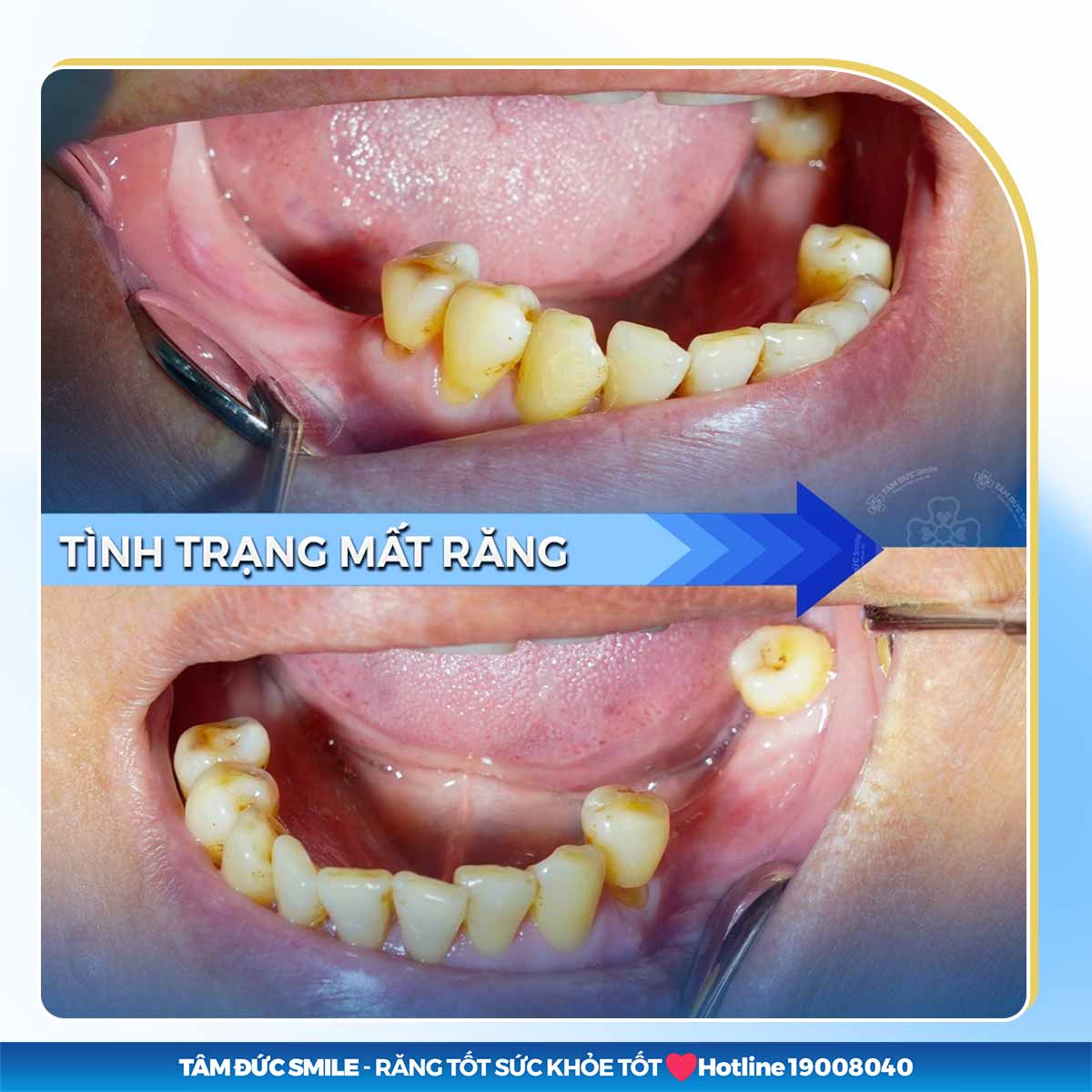 MẤT RĂNG LÂU NĂM CÓ TRỒNG RĂNG IMPLANT ĐƯỢC KHÔNG?