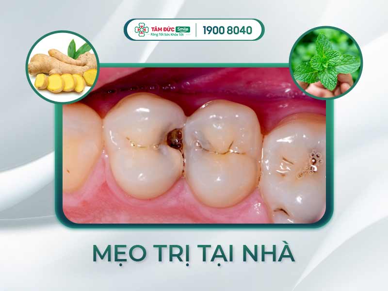 MẸO TRỊ SÂU RĂNG HÔI MIỆNG ĐƠN GIẢN, THỰC HIỆN NGAY TẠI NHÀ
