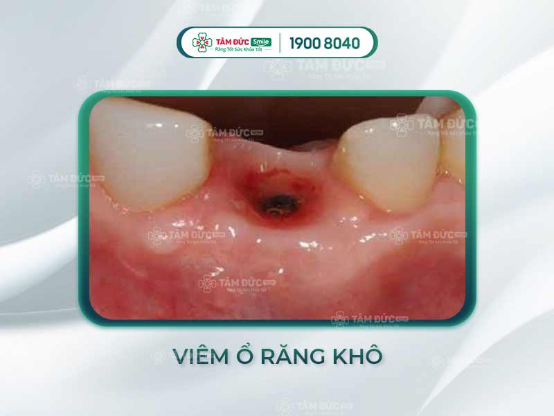 MỨC ĐỘ NGUY HIỂM CỦA VIÊM Ổ RĂNG KHÔ -  CÁCH KHẮC PHỤC