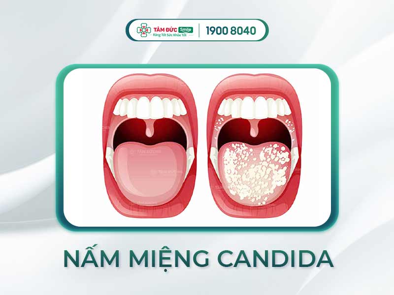 NẤM MIỆNG CANDIDA: NHẬN BIẾT, ĐIỀU TRỊ VÀ PHÒNG NGỪA