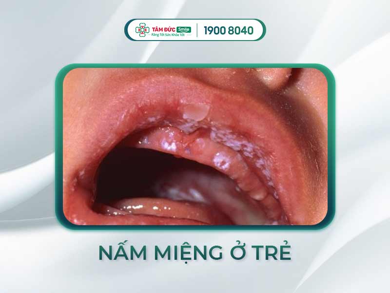 NẤM MIỆNG Ở TRẺ 2 TUỔI: NGUYÊN NHÂN VÀ PHƯƠNG PHÁP ĐIỀU TRỊ
