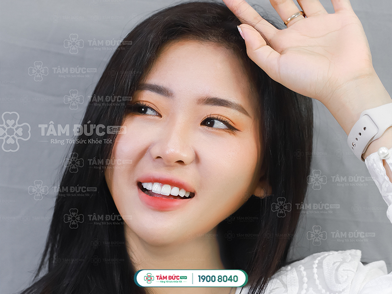 NÊN CHỌN MẶT DÁN SỨ VENEER HAY BỌC RĂNG SỨ THẨM MỸ