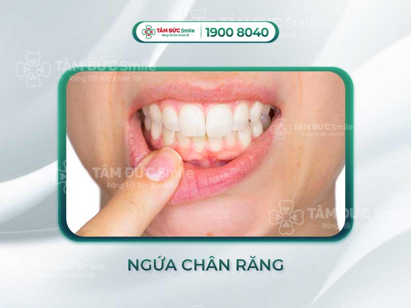 NGỨA CHÂN RĂNG, NƯỚU RĂNG LÀ BỆNH GÌ? CÁCH CHỮA TRỊ HIỆU QUẢ