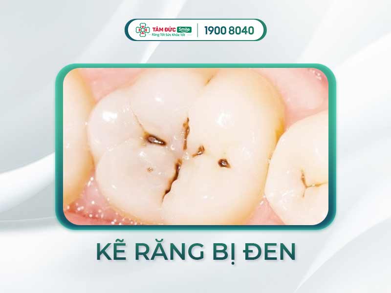 5 NGUYÊN NHÂN LÀM KẼ RĂNG BỊ ĐEN VÀ CÁCH KHẮC PHỤC, PHÒNG NGỪA