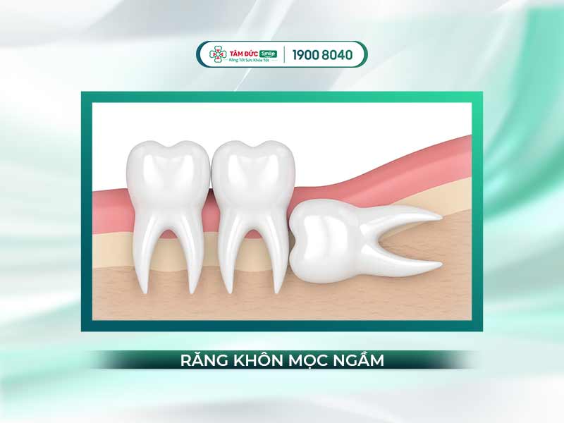 VÌ SAO CÓ RĂNG MỌC NGẦM? DẤU HIỆU RĂNG MỌC NGẦM VÀ CÁCH LOẠI BỎ KHÔNG ĐAU