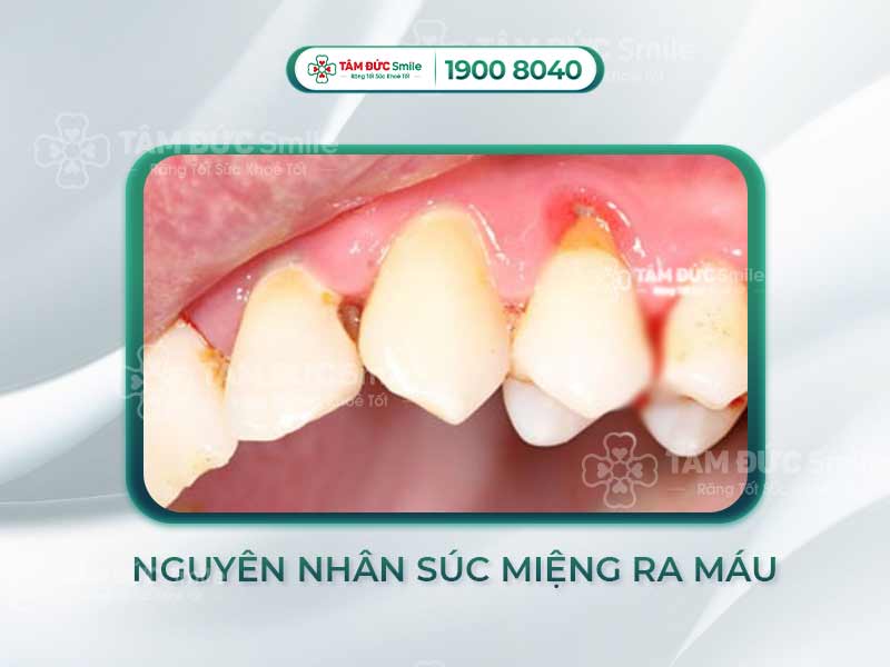 3+ NGUYÊN NHÂN SÚC MIỆNG RA MÁU VÀ GIẢI PHÁP KHẮC PHỤC