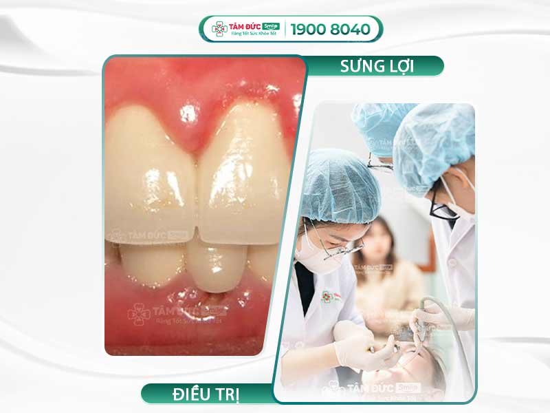 NGUYÊN NHÂN GÂY SƯNG LỢI RĂNG CỬA? PHƯƠNG PHÁP ĐIỀU TRỊ HIỆU QUẢ NHẤT