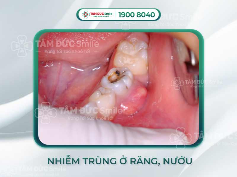 NHIỄM TRÙNG RĂNG CÓ NGUY HIỂM KHÔNG? DẤU HIỆU NHẬN BIẾT NHIỄM TRÙNG RĂNG VÀ CÁCH GIẢI QUYẾT