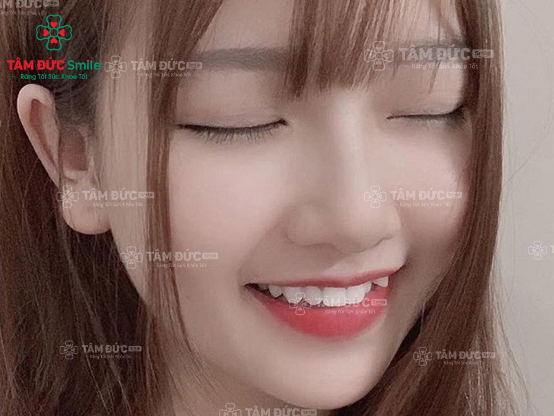 trồng răng khểnh tạo nên nét cười duyên dáng