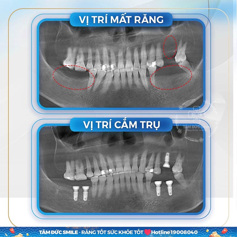 Implant nha khoa là gì