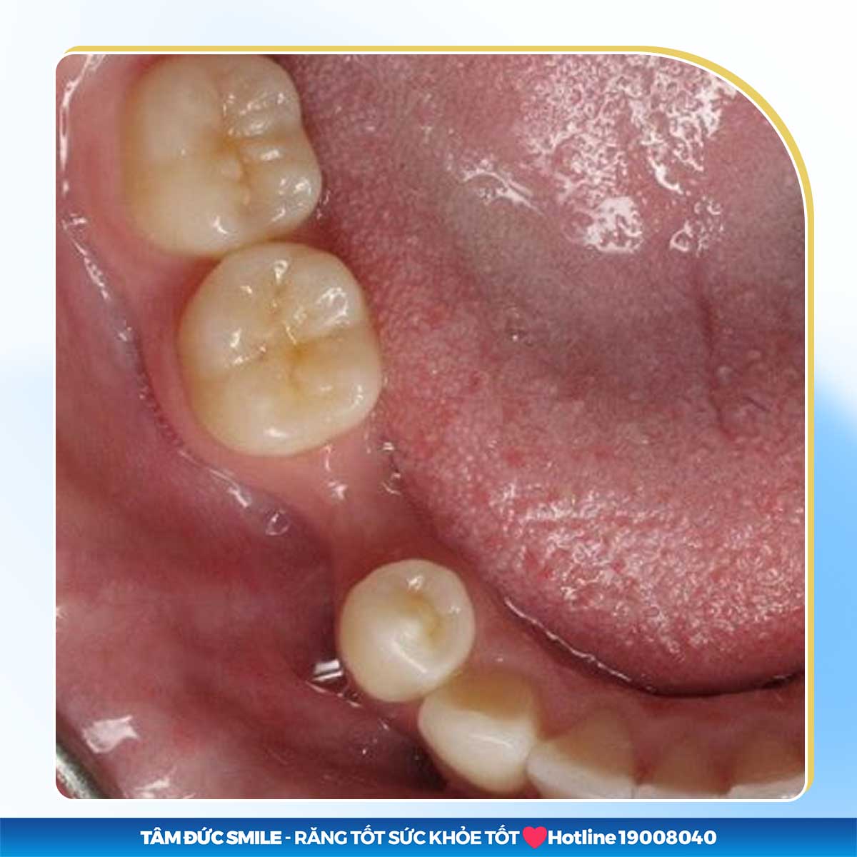 mất răng lâu dẫn đến hiện tượng tiêu xương hàm