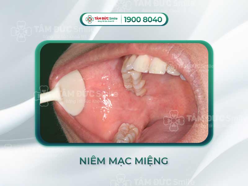 NIÊM MẠC MIỆNG LÀ GÌ? DẤU HIỆU NHẬN BIẾT NIÊM MẠC MIỆNG BÌNH THƯỜNG VÀ BẤT THƯỜNG
