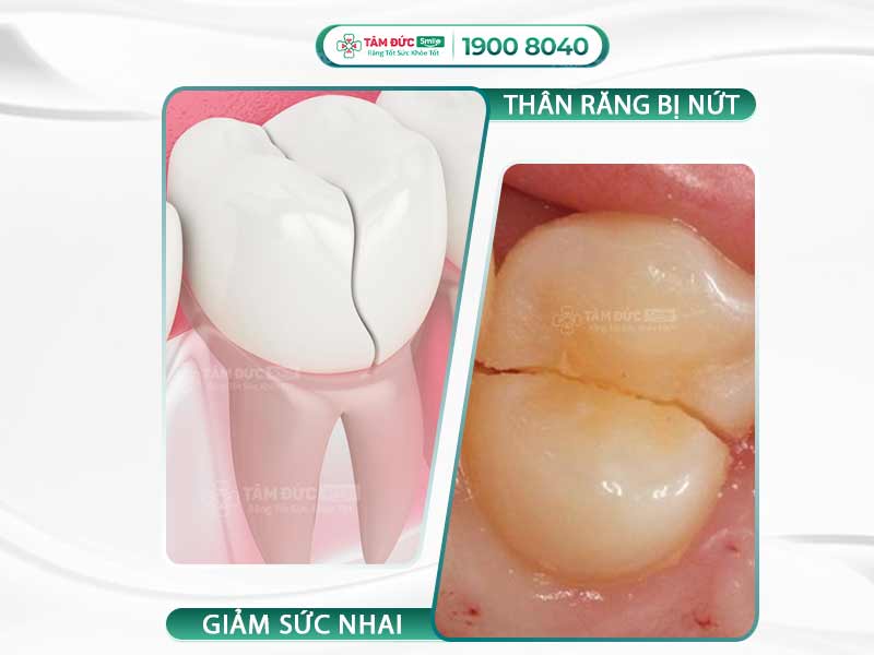 NỨT DỌC THÂN RĂNG PHẢI LÀM SAO? RĂNG CÓ TỰ LÀNH ĐƯỢC KHÔNG?
