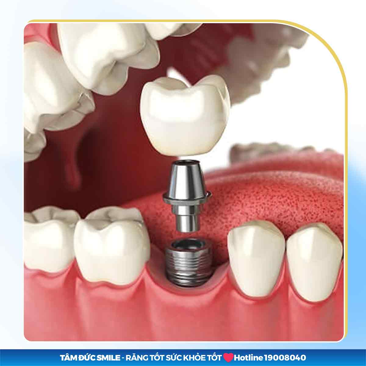 PHỤC HÌNH RĂNG SỨ TRÊN IMPLANT NGAY SAU KHI CẤY GHÉP