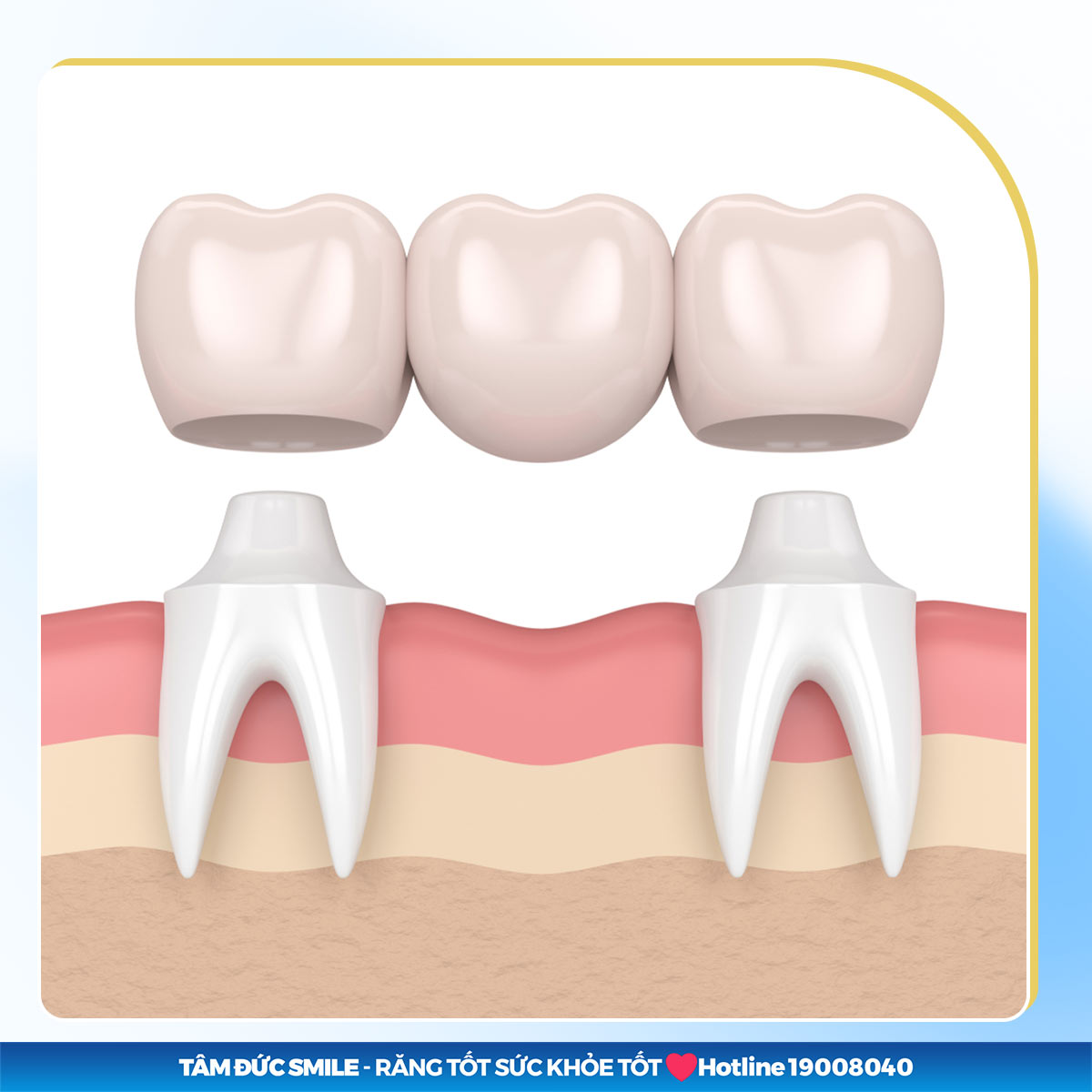 trồng răng hàm bị sâu