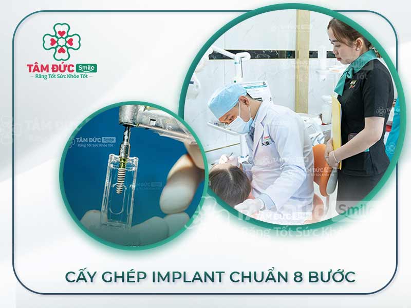 QUY TRÌNH CẤY GHÉP IMPLANT ĐƯỢC THỰC HIỆN NHƯ THẾ NÀO?