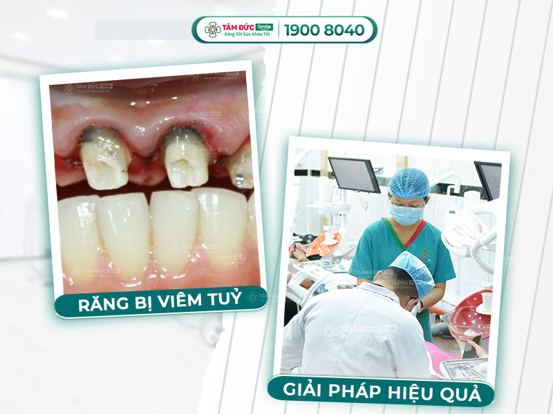 RĂNG BỌC SỨ BỊ VIÊM TỦY PHẢI LÀM SAO? 3 BƯỚC KHẮC PHỤC HIỆU QUẢ