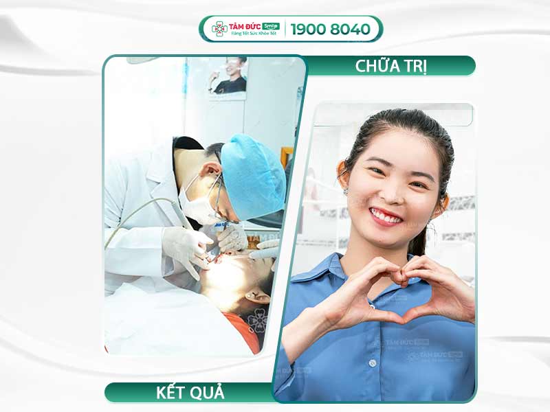 RĂNG LUNG LAY LÀM SAO ĐỂ CHẮC LẠI? CÁCH CHỮA RĂNG LUNG LAY TẠI NHÀ